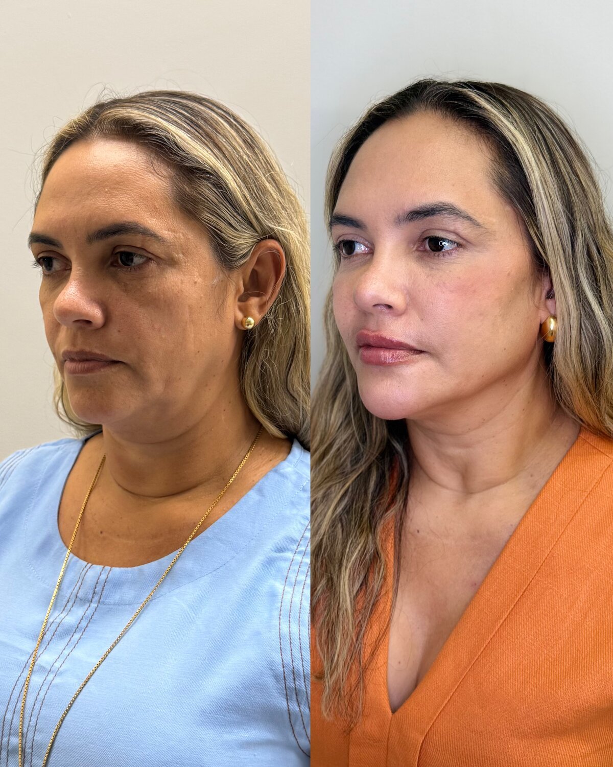 Resultado de rejuvenescimento antes e depois do Instituto Welisson Carvalho